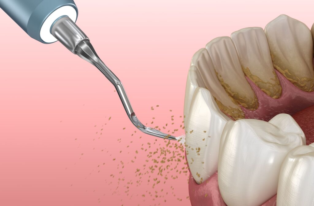 Illustration of dental scaling tool removing tartar from teeth.