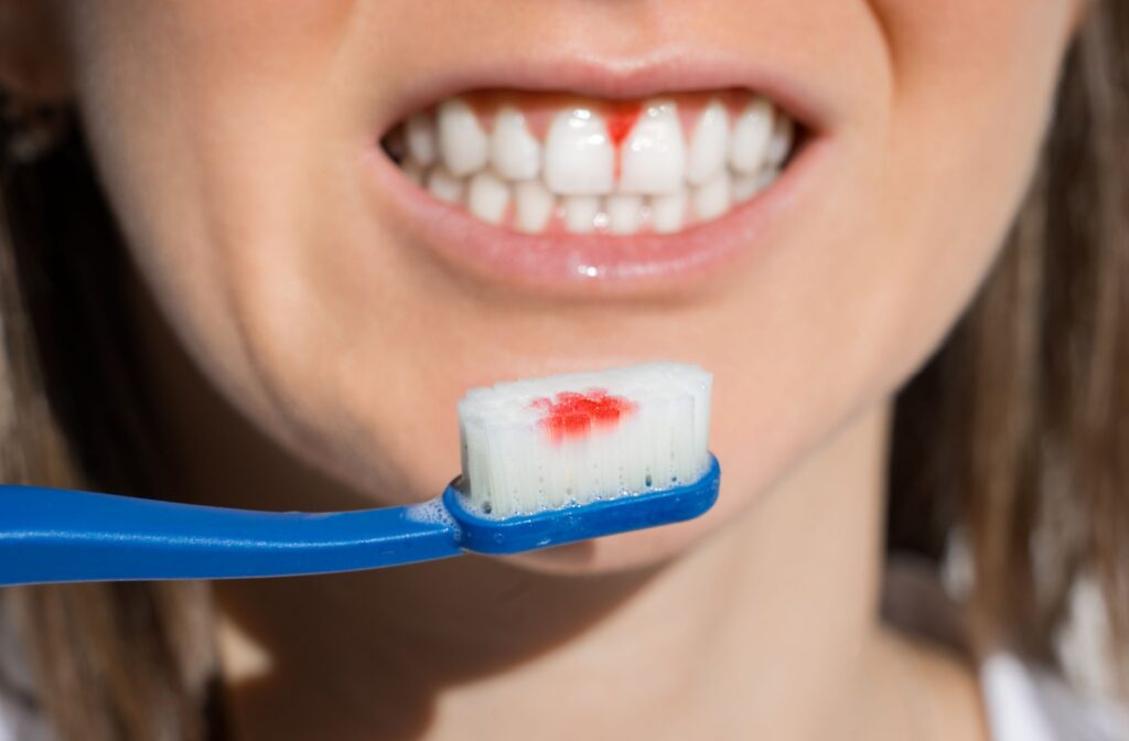 Close-up of a woman’s smile showing bleeding gums and a toothbrush with blood after brushing.
