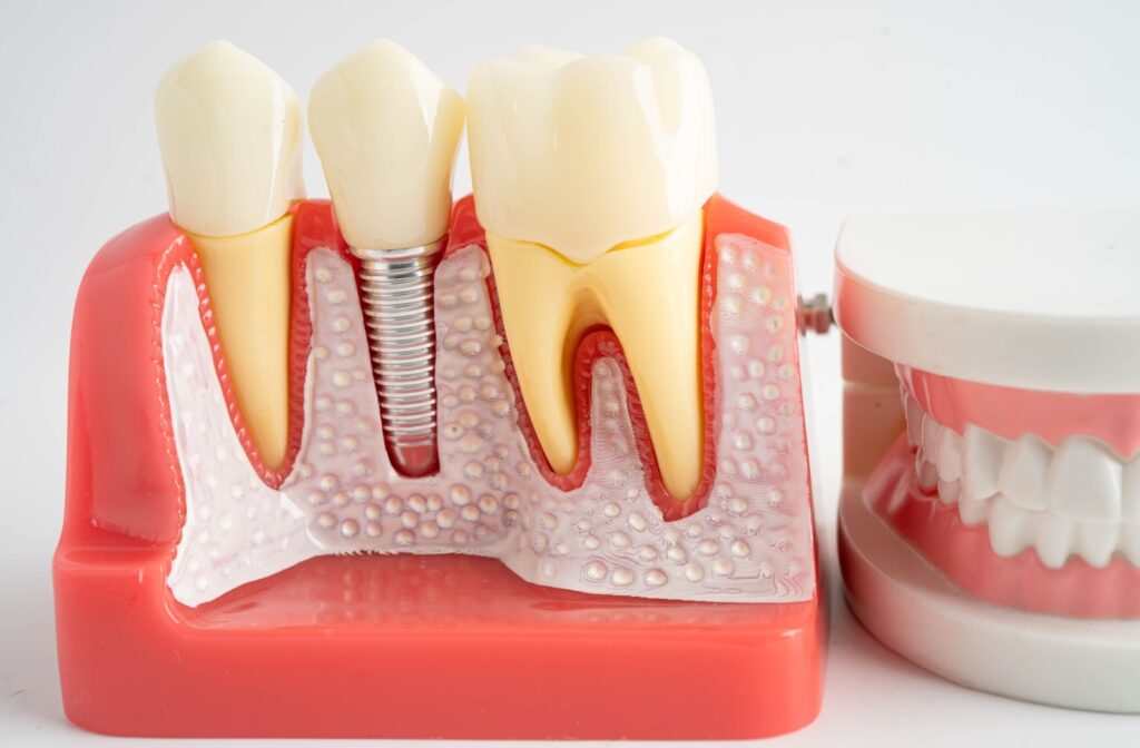 Close-up cross-sectional model of a dental implant next to natural teeth, showing the implant post integrated into the jawbone beneath the gumline.