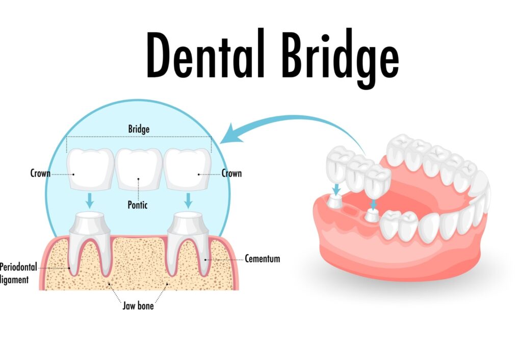 Illustration showing a dental bridge with labeled parts including crowns, pontic, periodontal ligament, cementum, and jawbone, alongside a 3D view of how the bridge fits into the mouth.