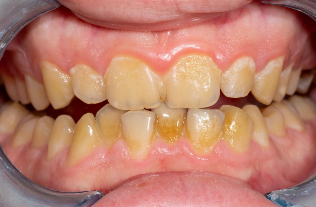 Close-up of teeth with heavy plaque and tartar buildup along the gumline, showing early signs of gum disease.