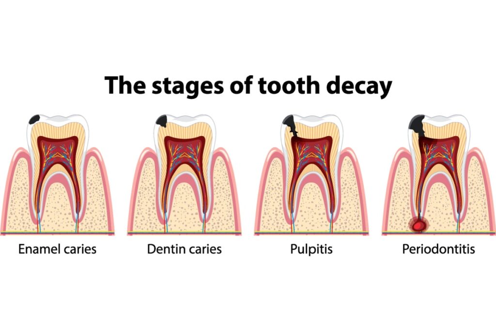 Diagram showing the four stages of tooth decay: enamel caries, dentin caries, pulpitis, and periodontitis, with progressive deterioration visible in cross-section tooth illustrations.