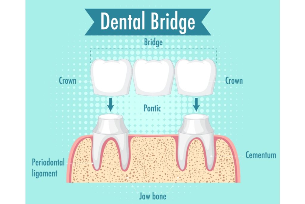 Medical diagram showing dental bridge structure with labeled components including crowns, pontic, cementum, periodontal ligament, and jaw bone.