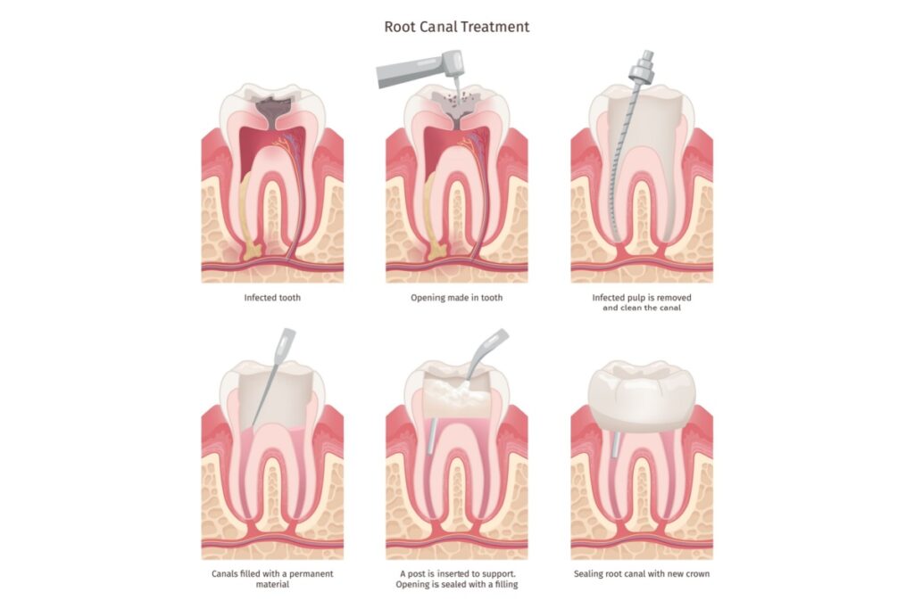 Root canal treatment procedure steps diagram.