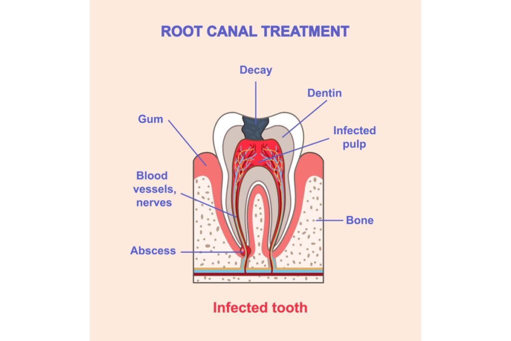 Root canal treatment single tooth illustration cross section.